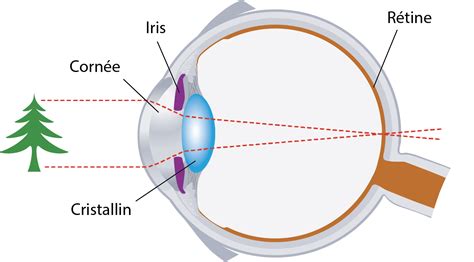 Illustration montrant un œil avec et sans reflet lumineux pour comparer l'impact visuel.
